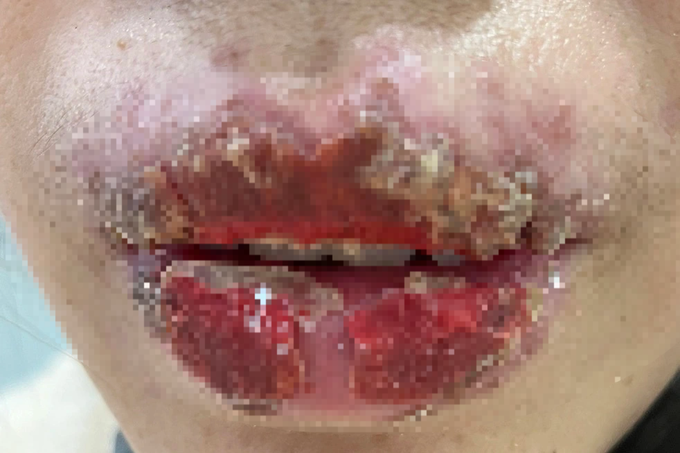 Hà Nội: Nữ sinh lớp 10 môi như tổ ong sau khi cùng chị đi xăm - 1