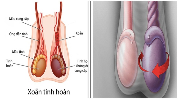 Chàng trai mất một bên tinh hoàn chỉ vì chủ quan - 1