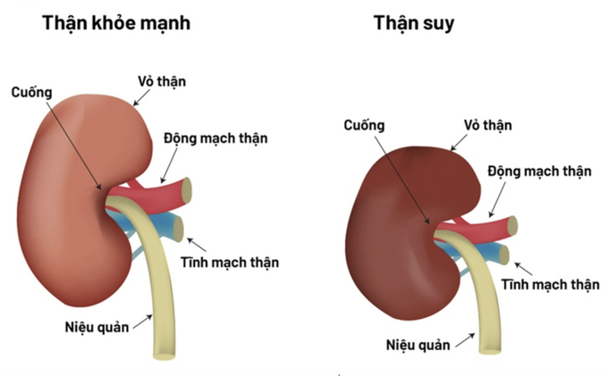 Uống cỏ mực chữa suy thận theo bác sĩ Google, nữ bệnh nhân lâm nguy - 2