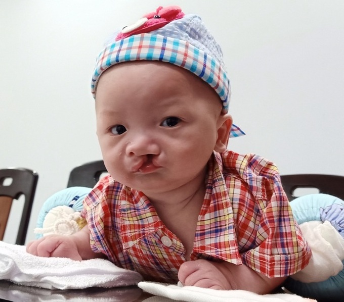 Abandoned baby with cleft palate sent to social protection centre - 1 Abandoned baby with cleft palate sent to social protection centre - 1