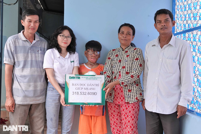 Severely-burnt boy receives support - 1