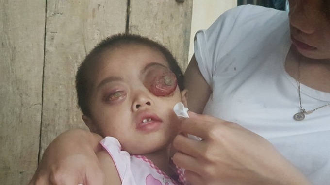 Plea to save little girl from brain cancer blindness - 1 Plea to save little girl from brain cancer blindness - 1