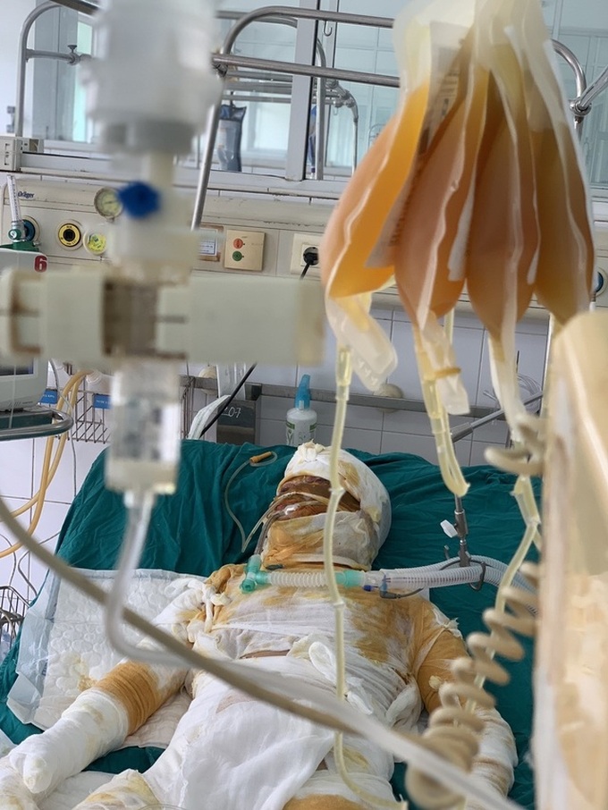 Burn victims in desperate need of help to survive - 2