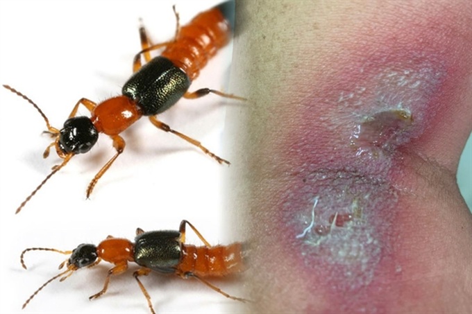 HCM City locals suffer from rove beetles during rainy season - 1 HCM City locals suffer from rove beetles during rainy season - 1