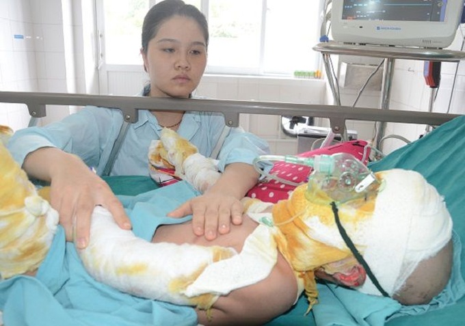 Ill boy continues suffering from fire burns - 1