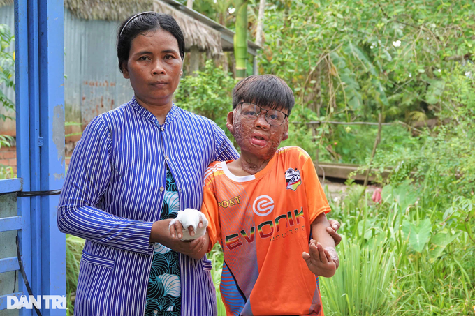 Seriously-burnt boy in desperate need of support - 1