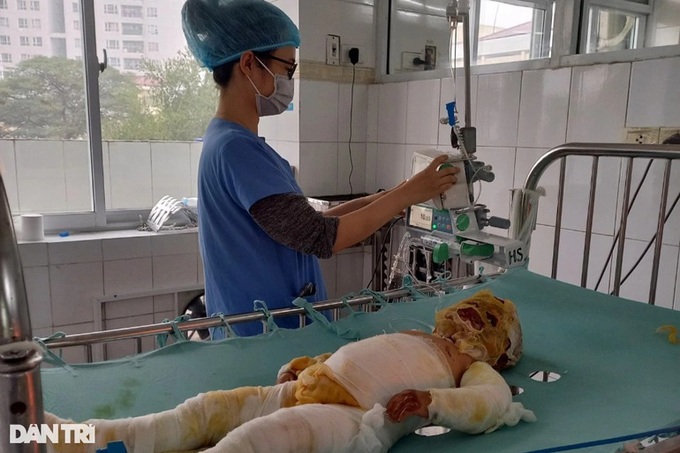 Little girl facing serious burns in dire need of help - 1