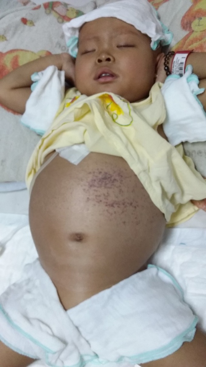 Small baby girl struggles against leukaemia - 1 Small baby girl struggles against leukaemia - 1