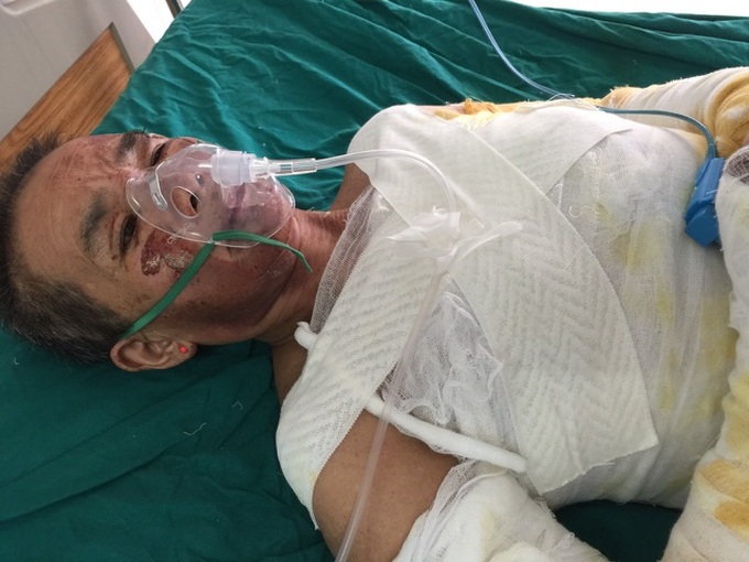 Family in critical condition after fire accident - 1 Family in critical condition after fire accident - 1