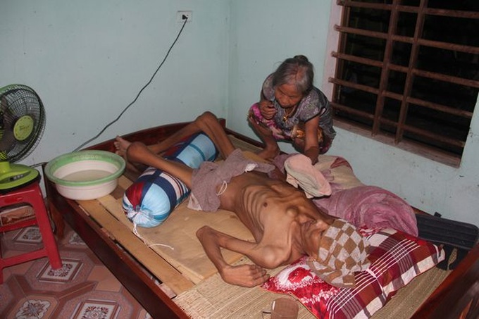 Man struggling with osteoma needs help - 1