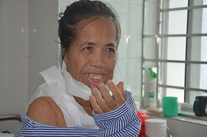 Woman suffering from horrific facial burns has life-transforming operation - 1