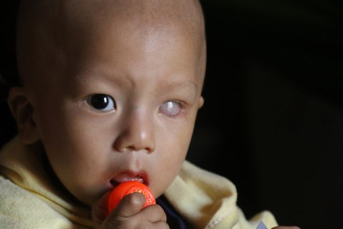 Little boy at risk of going blind from cancer - 1