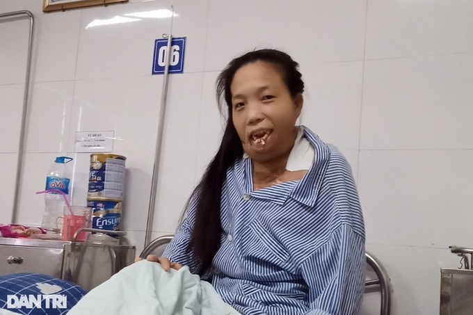 Poor woman receives support to treat serious burns - 2