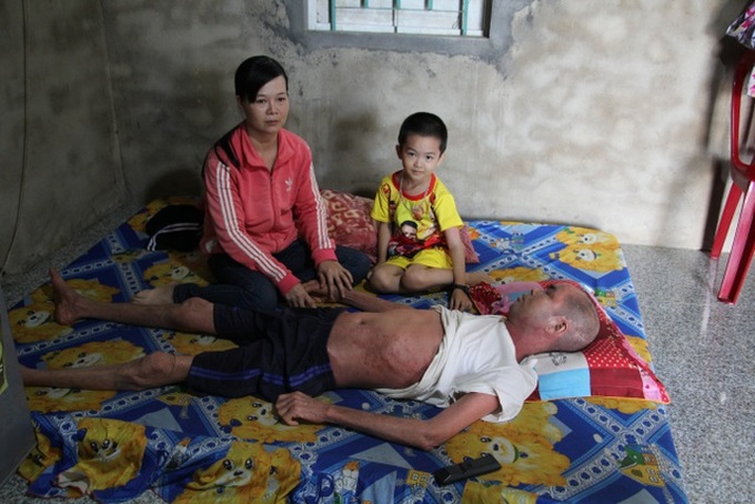 Dak Lak man suffers from psoriasis and stroke effects - 2 Dak Lak man suffers from psoriasis and stroke effects - 2