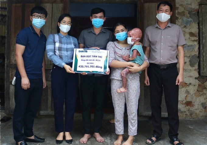 Readers help little boy with severe burns - 1