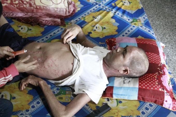 Dak Lak man suffers from psoriasis and stroke effects - 1 Dak Lak man suffers from psoriasis and stroke effects - 1