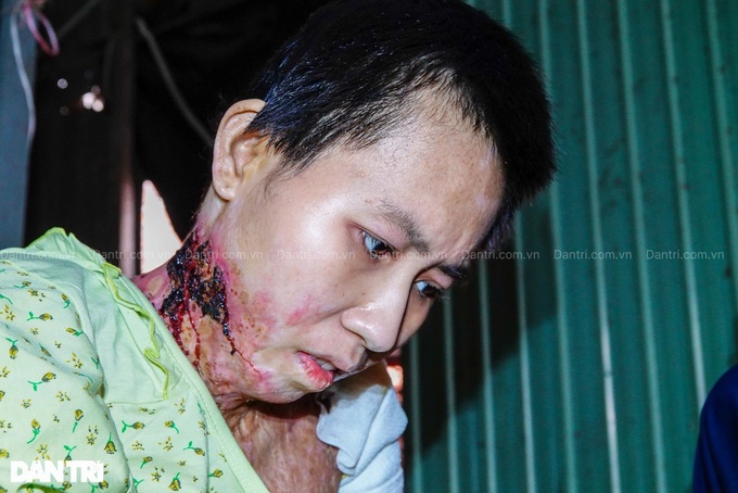 Woman needs support to treat severe burns - 2
