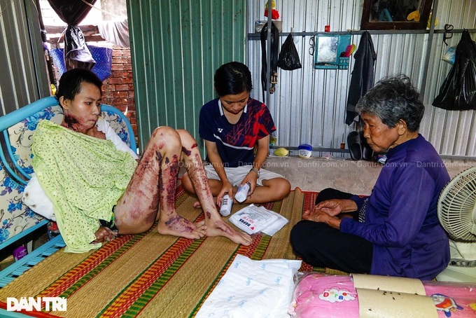 Woman needs support to treat severe burns - 1