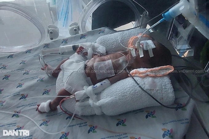 Couple need support to save premature baby - 1