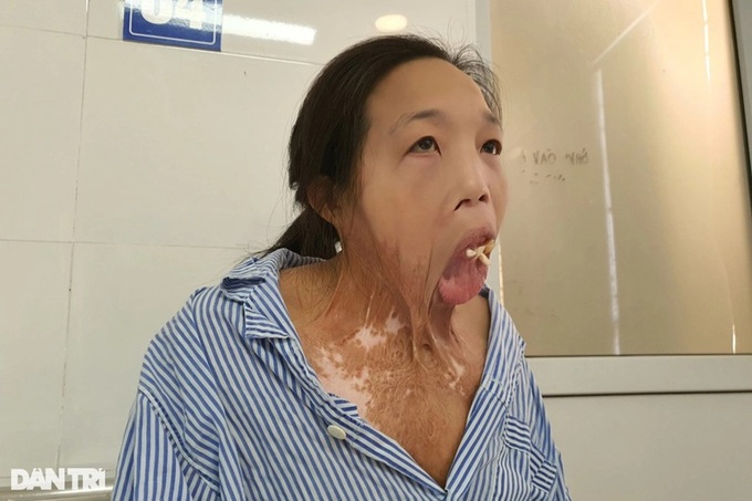 Poor woman receives support to treat serious burns - 1