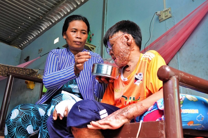 Seriously-burnt boy in desperate need of support - 2