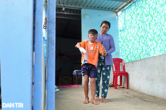 Severely-burnt boy receives support - 2