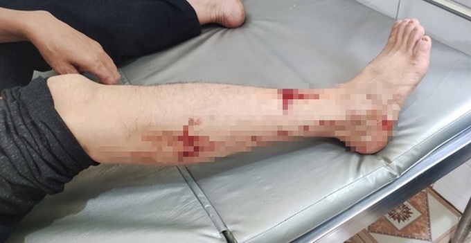 Man injured by rare langur in Bac Kan - 1 Man injured by rare langur in Bac Kan - 1