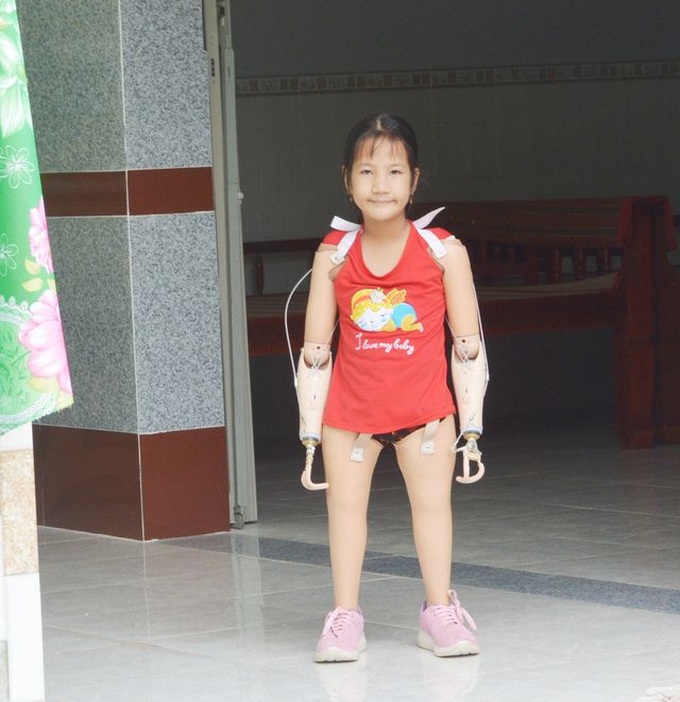 Limbless girl receives artificial arms and legs - 1