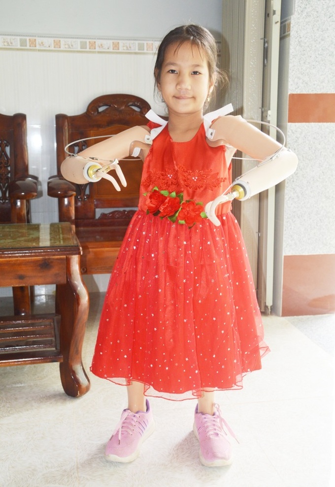 Limbless girl receives artificial arms and legs - 3