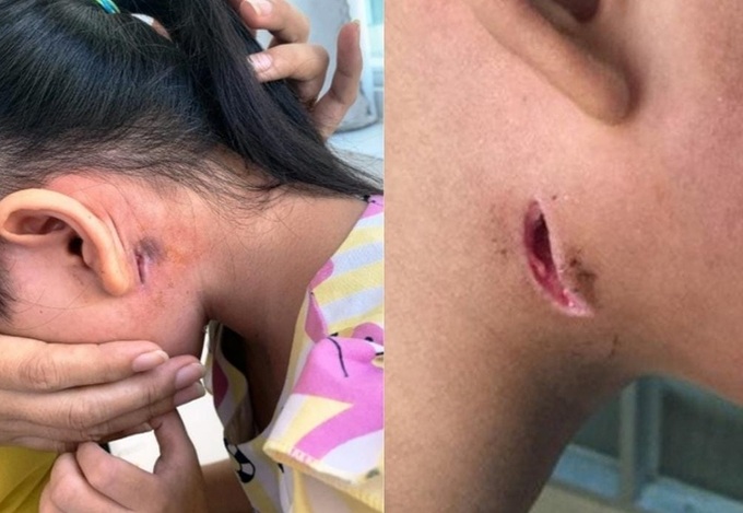 Health ministry issues Whitmore disease warning after teen death - 1 Health ministry issues Whitmore disease warning after teen death - 1