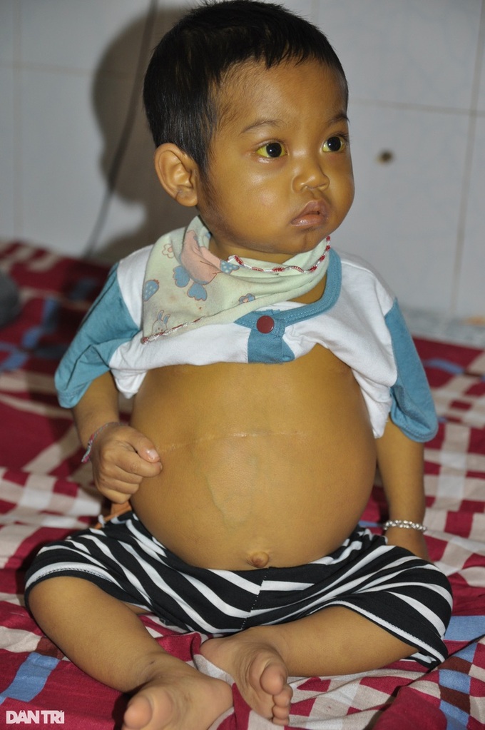 Little boy struggling with biliary atresia needs help - 1