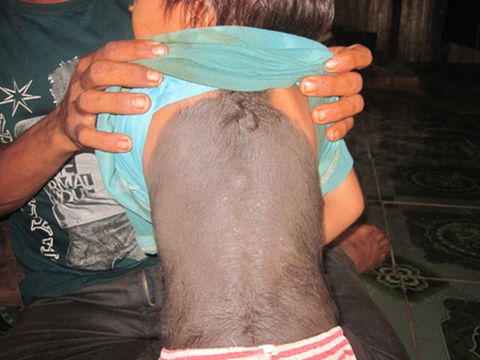 Ethnic J'Rai couple need help for disabled daughter - 2