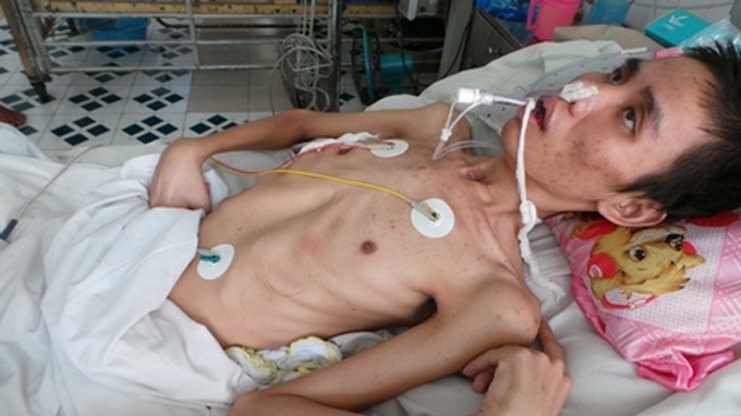 Young man with acute nerve inflammation in desperate fight for survival - 2 Young man with acute nerve inflammation in desperate fight for survival - 2