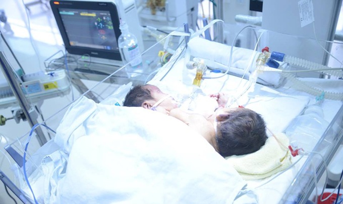 Conjoined twins in Ha Giang die - 1