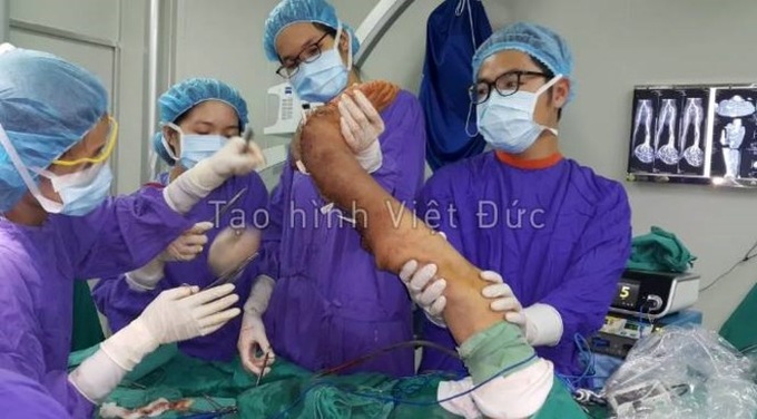 Surgeons remove 10kg tumour from a woman's leg - 3