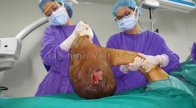 Surgeons remove 10kg tumour from a woman's leg - 2