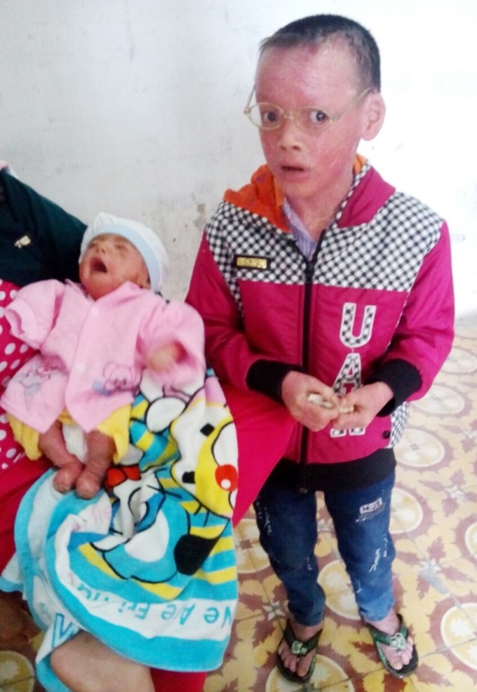 Brothers suffer from fish scale disease - 1 Brothers suffer from fish scale disease - 1