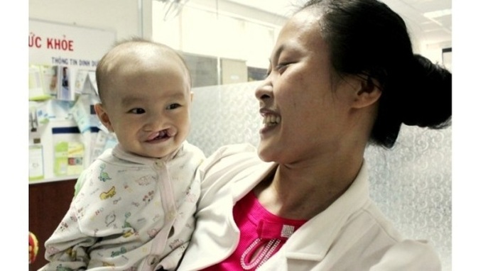 Nearly 300 children with cleft lips and palates to receive free operations in October - 1