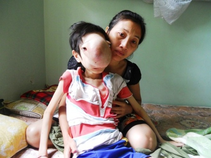 Boy with large facial tumour needs medical treatment - 1