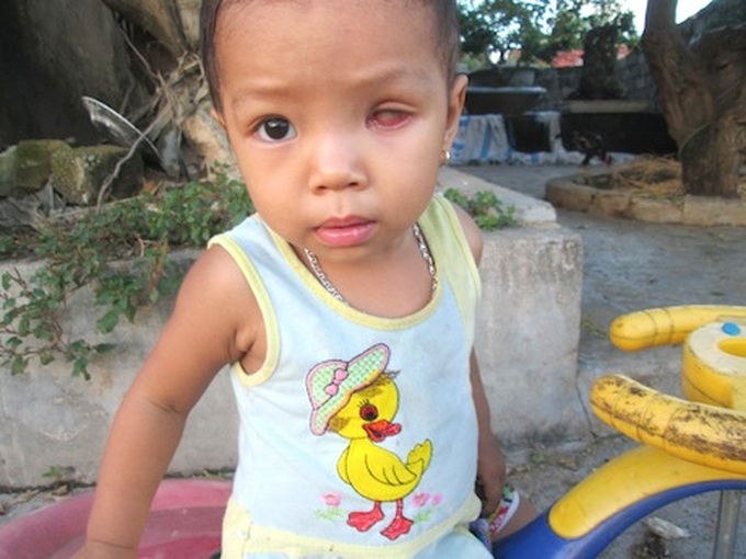 Little girl struggles with eye cancer - 1