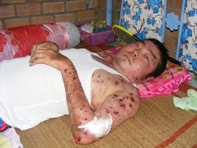 Young man with thrombocytopenia hoping in vain for survival - 2 Young man with thrombocytopenia hoping in vain for survival - 2