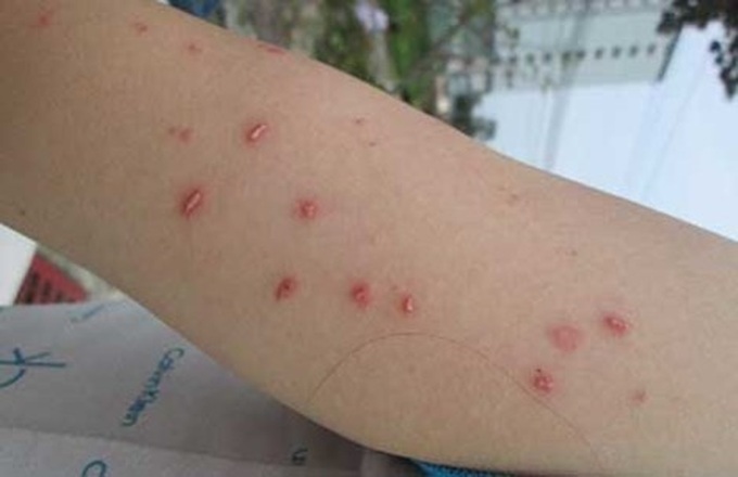Insects infest Hanoi residential areas - 2 Insects infest Hanoi residential areas - 2