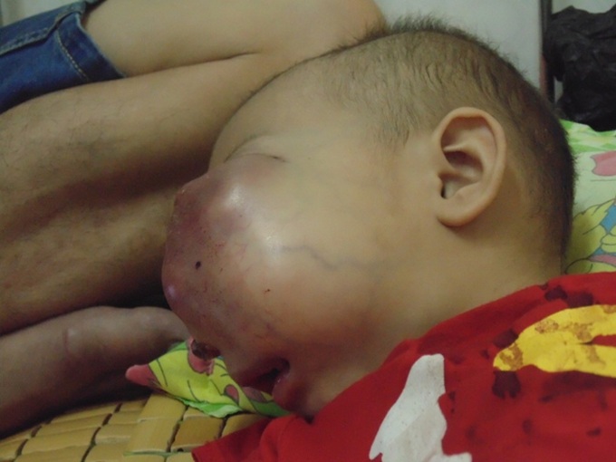 Little girl suffers from large tumour - 1 Little girl suffers from large tumour - 1