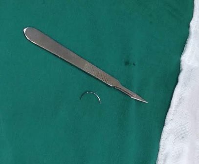 Surgical tool left inside patient for 15 years - 1