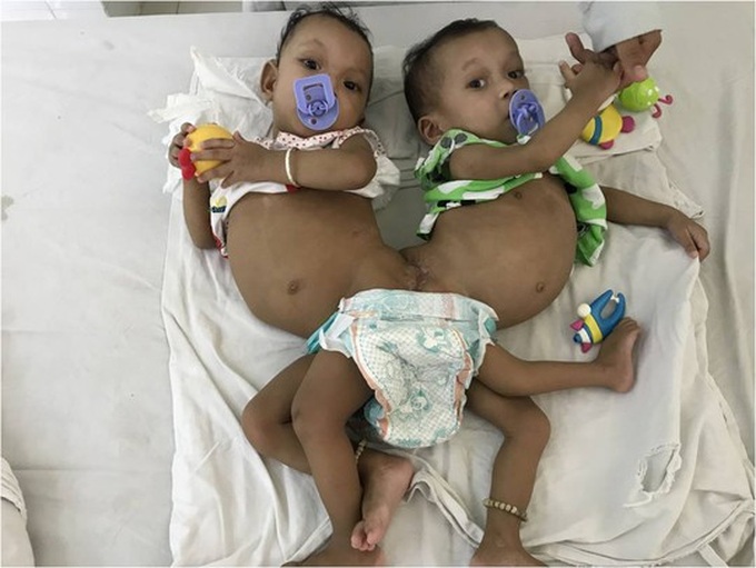 Rare case of twins conjoined at pelvis separated - 1
