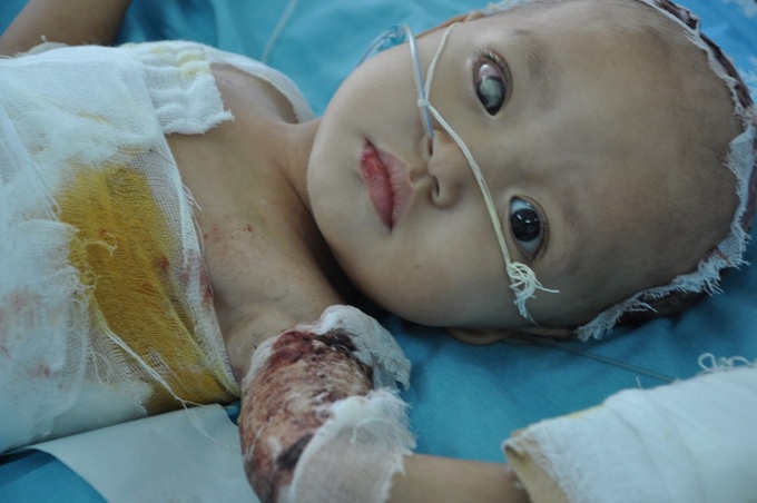 Two-year-old burn victim needs corneal donor - 1