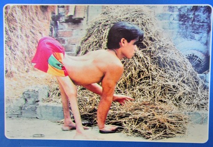Exhibition features moving photos of AO/dioxin victims - 3 Exhibition features moving photos of AO/dioxin victims - 3