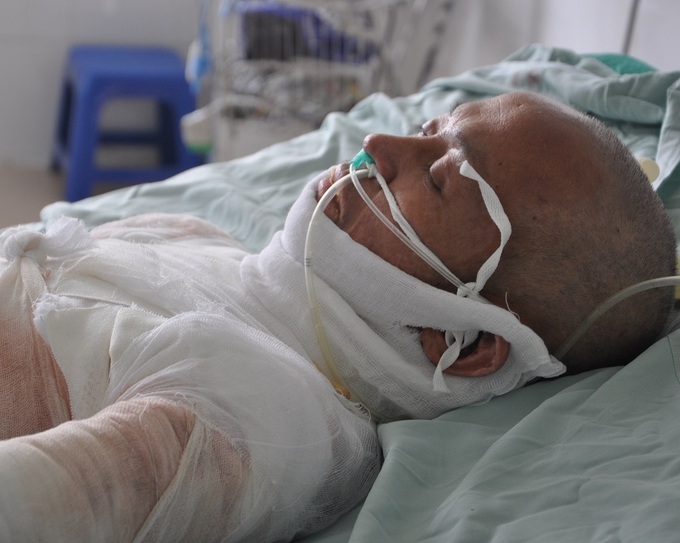 Wife faces ending treatment for badly burned husband - 1