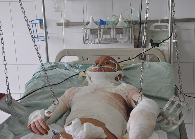 Wife faces ending treatment for badly burned husband - 3