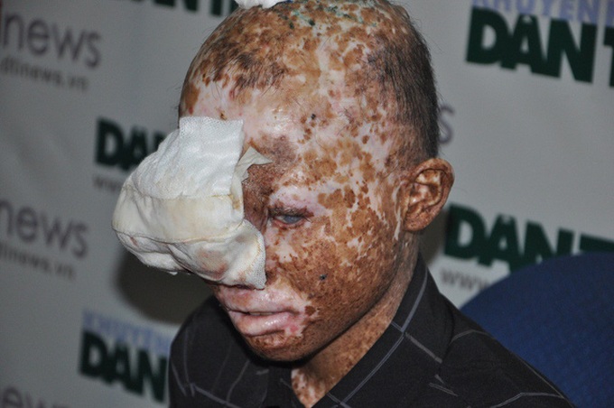 Teenager suffers from skin cancer - 1 Teenager suffers from skin cancer - 1